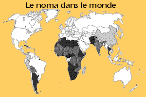 Planisphère des pays touchés par le Noma